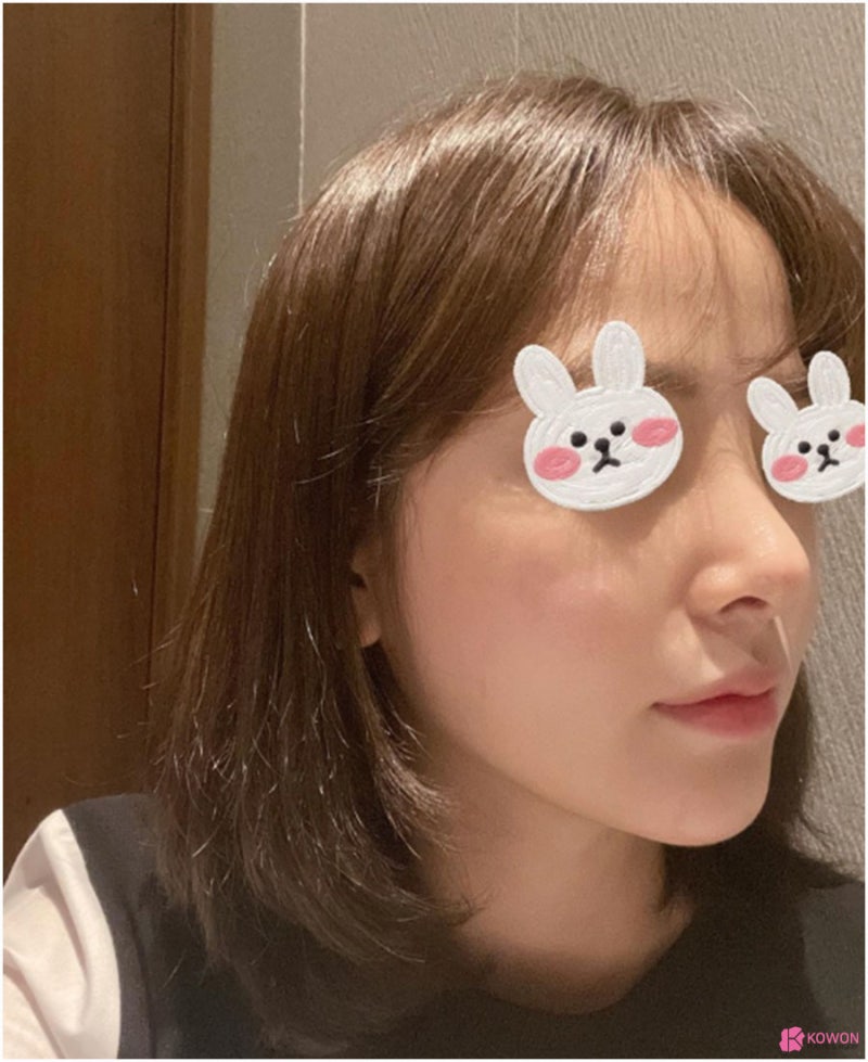 직반버선코 세련된 콧대 모양 논현동성형외과 사진 5