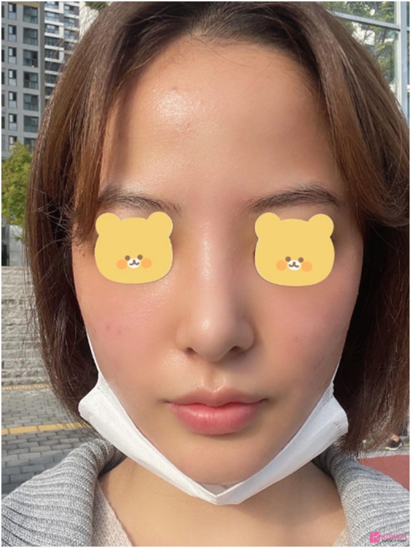 직반버선코 세련된 콧대 모양 논현동성형외과 사진 10