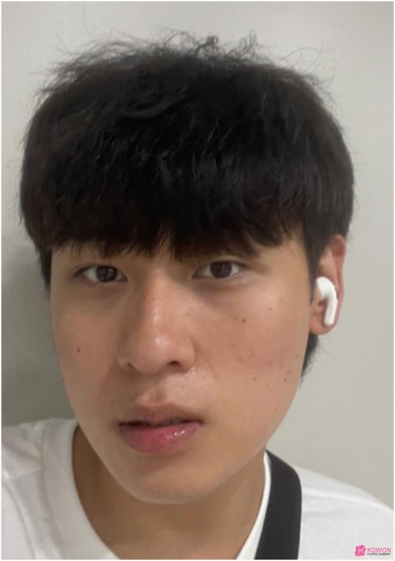 역삼동성형외과 심미성까지 잡은 강남비중격코수술 사진 2
