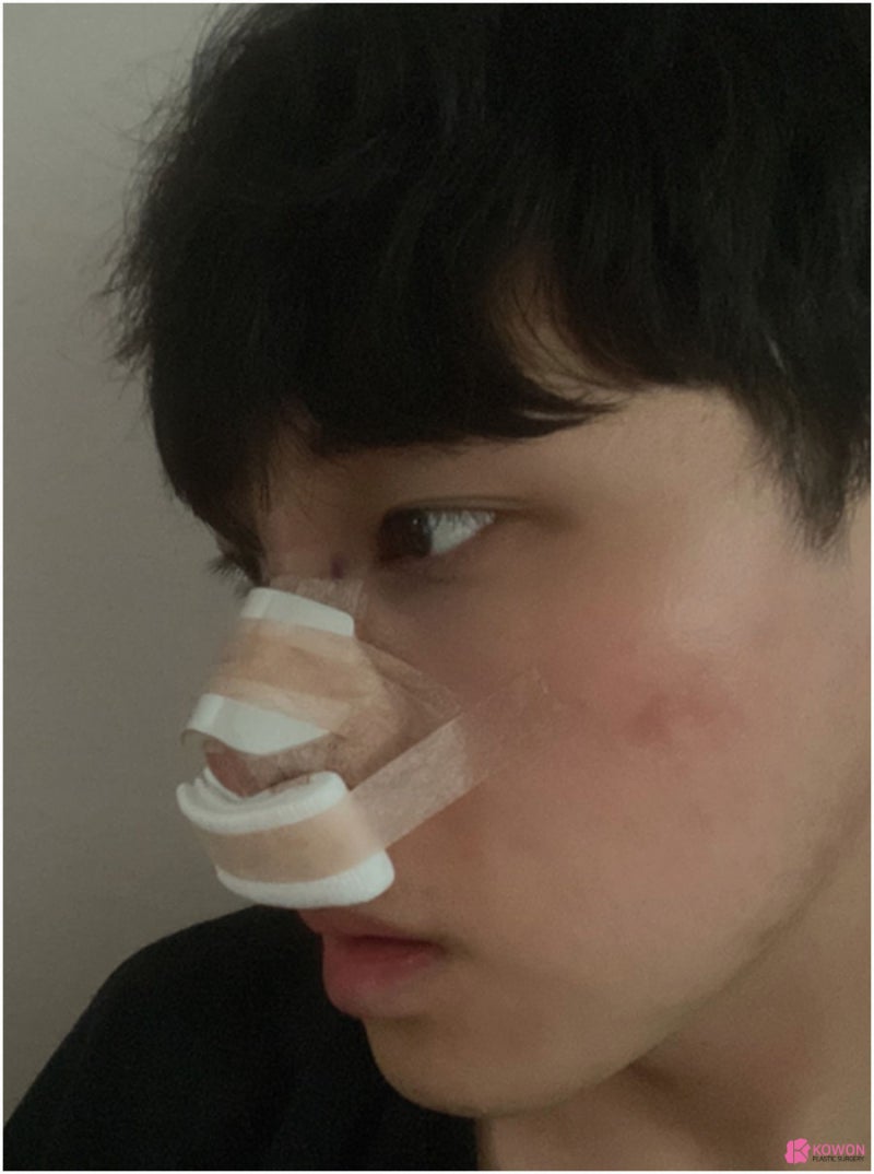 역삼동성형외과 심미성까지 잡은 강남비중격코수술 사진 3