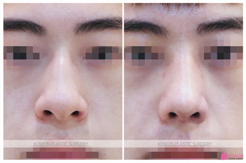 무보형물코수술 연골 이식 코잘하는성형외과 사진 6