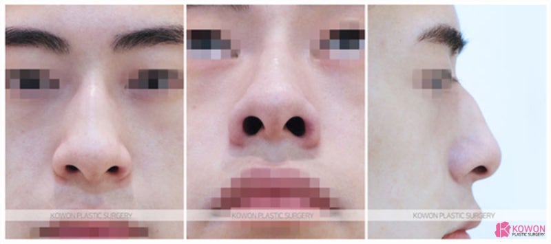 무보형물코수술 연골 이식 코잘하는성형외과 사진 2