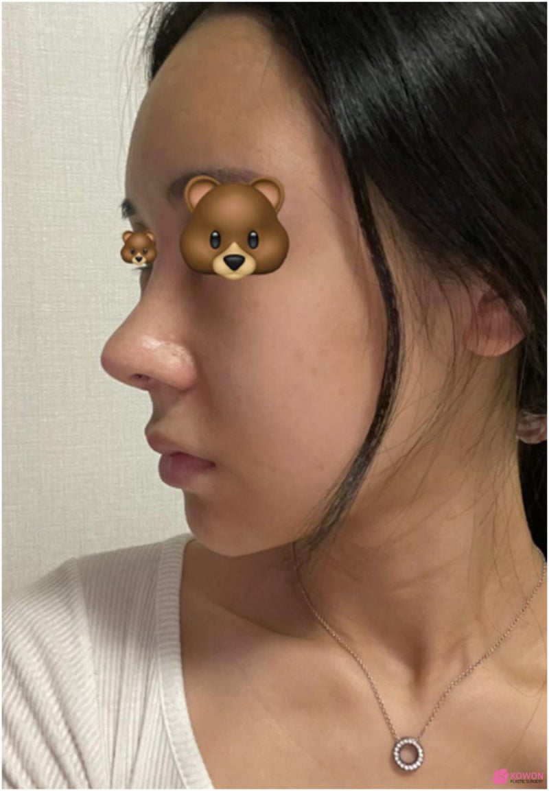압구정코성형외과 비순각수술 콤플렉스 개선 사진 6