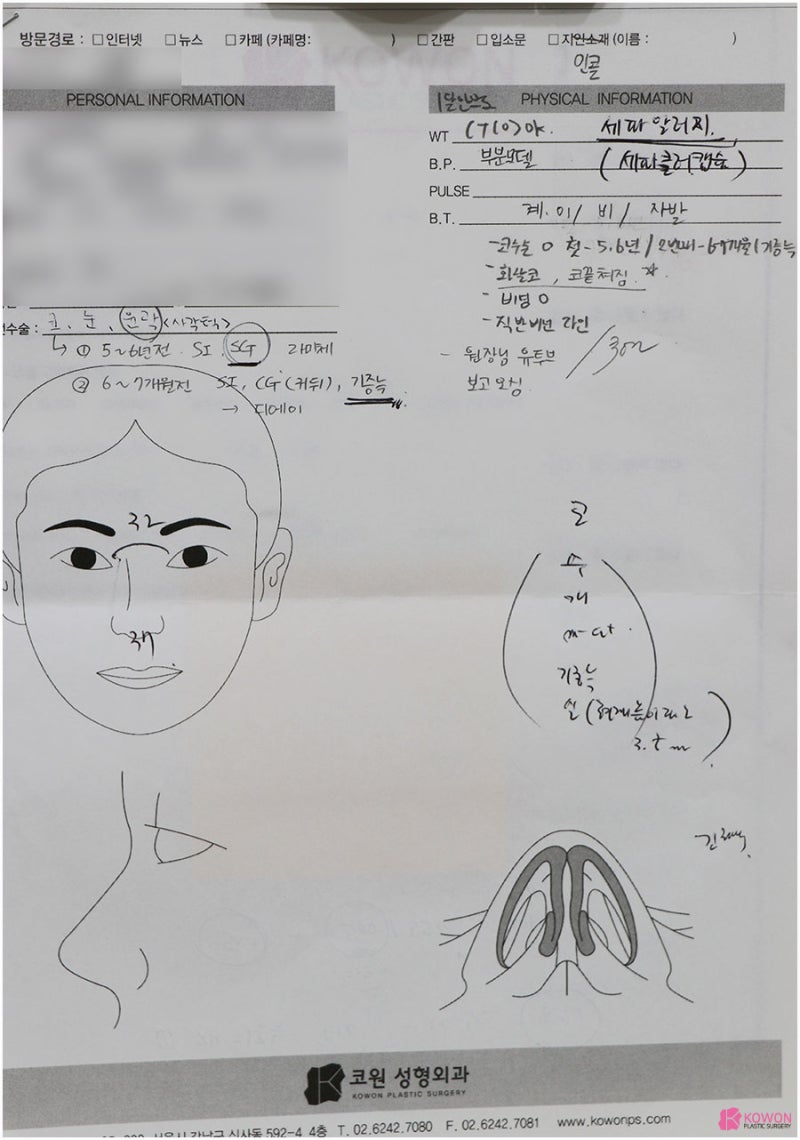 압구정코성형외과 비순각수술 콤플렉스 개선 사진 2