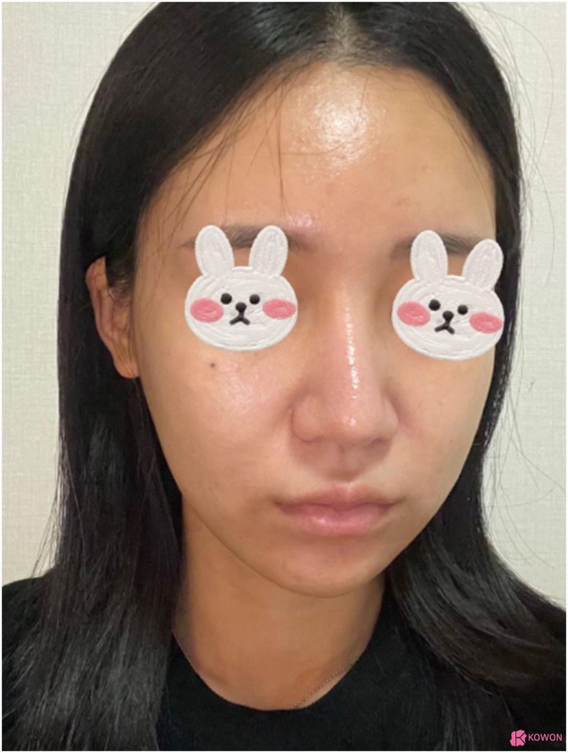 압구정코성형외과 비순각수술 콤플렉스 개선 사진 3