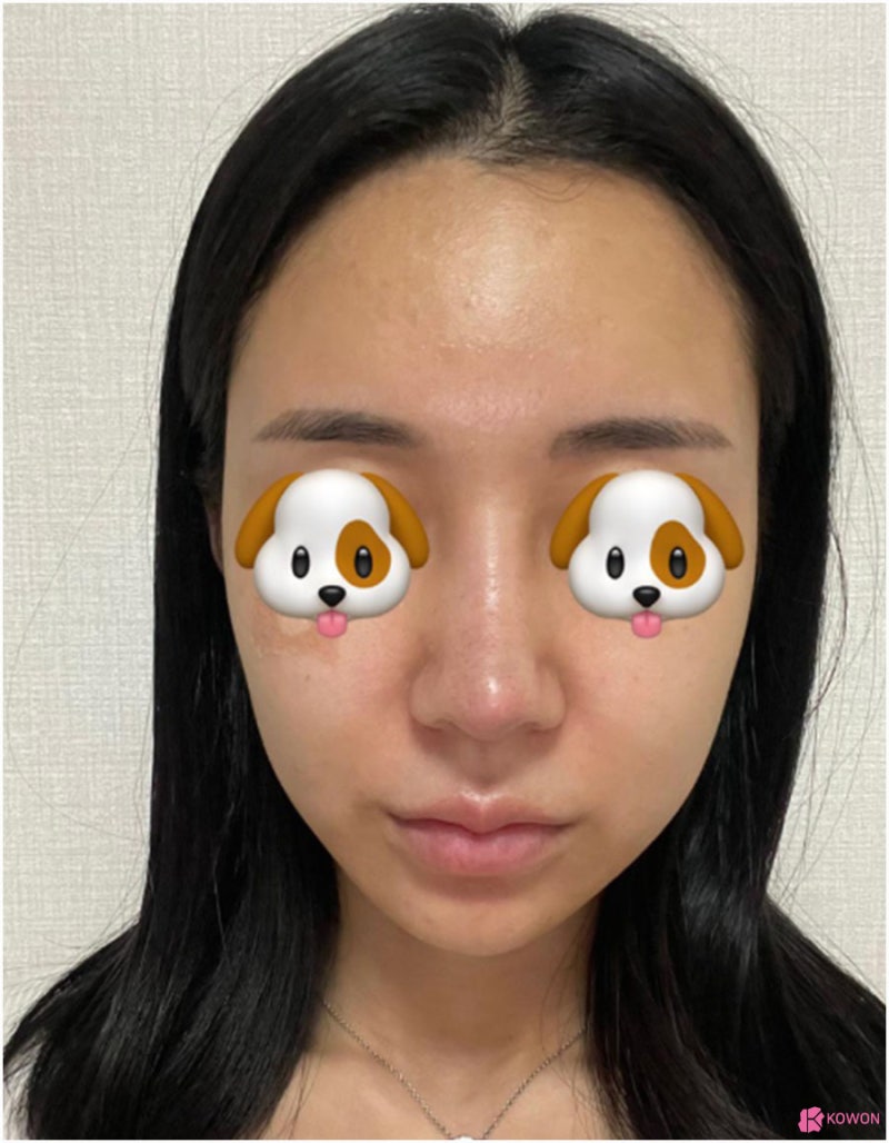 압구정코성형외과 비순각수술 콤플렉스 개선 사진 7