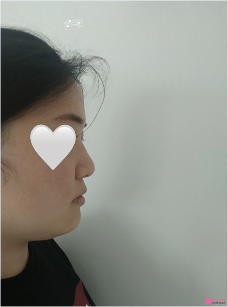 강남코성형외과추천 콧볼수술후기 문의 변화 전후차이 사진 2