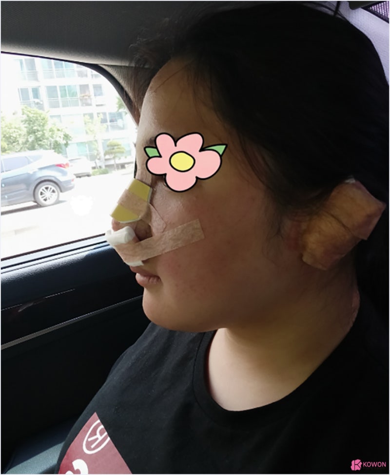 강남코성형외과추천 콧볼수술후기 문의 변화 전후차이 사진 7
