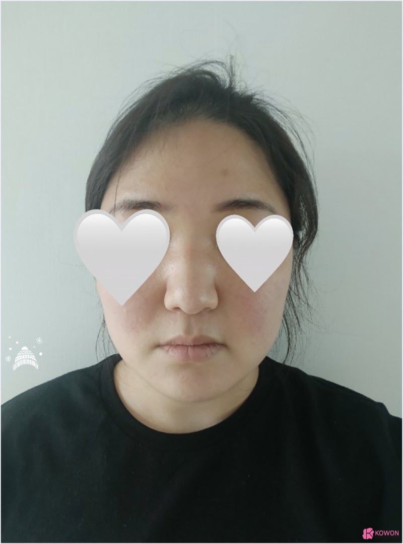 강남코성형외과추천 콧볼수술후기 문의 변화 전후차이 사진 4