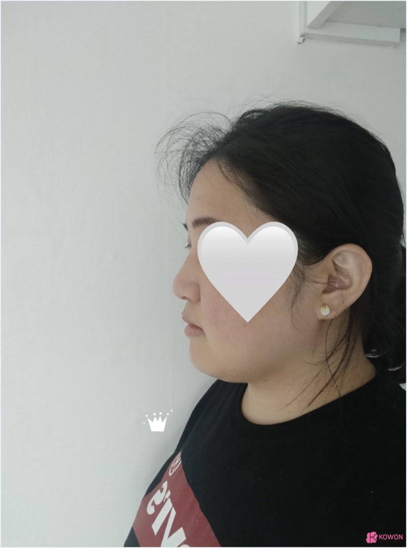 강남코성형외과추천 콧볼수술후기 문의 변화 전후차이 사진 3