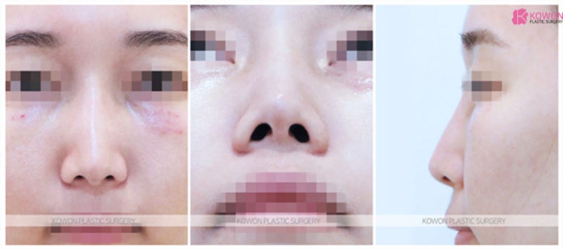 코실제거 통한 기존 모습 복원 코끝리프팅 사례 사진 2