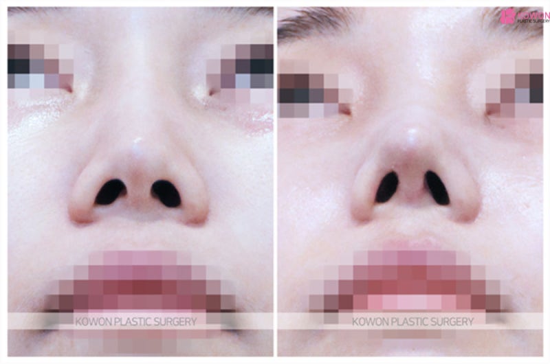 코실제거 통한 기존 모습 복원 코끝리프팅 사례 사진 6