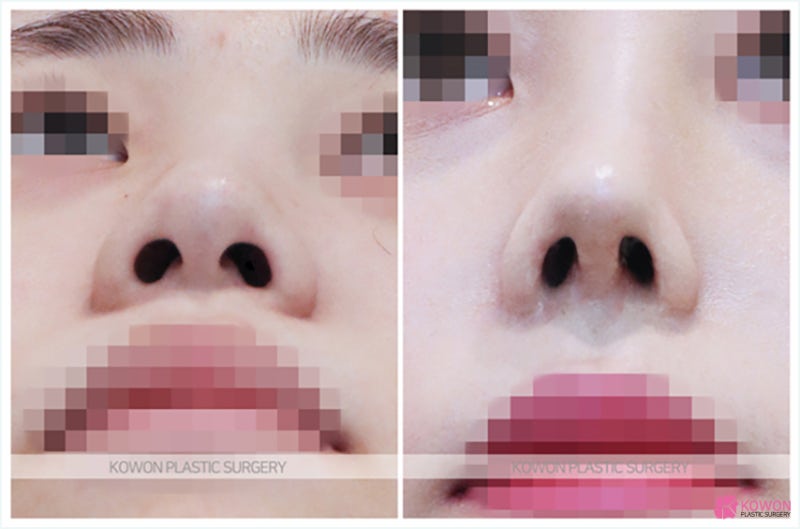강남성형외과순위 코필러퍼짐 현상 해결 인상 사진 6