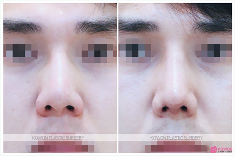 신사성형외과 낮은코성형후기 콧대 비중격 연골 대칭 사진 7