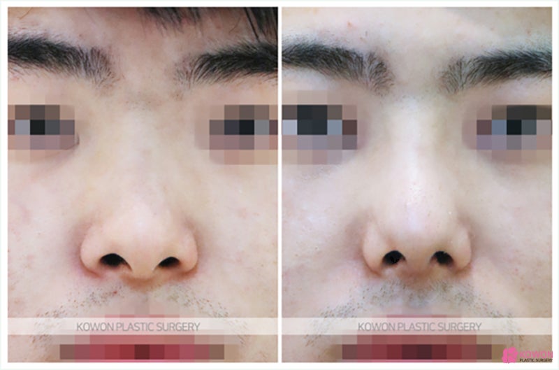 신사역성형외과 비염휜코 비중격만곡증 교정술 개선 사진 5