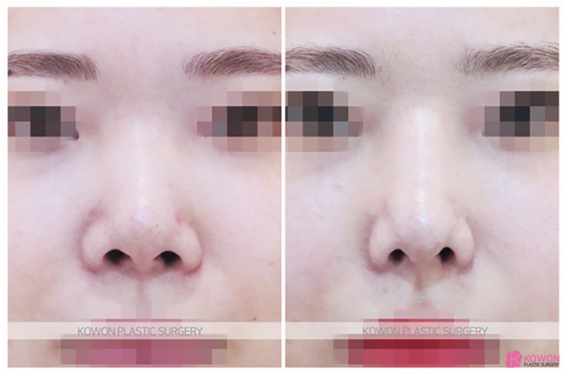 강남코재수술병원 자가늑코성형 콧날 매부리 절골법 사진 4