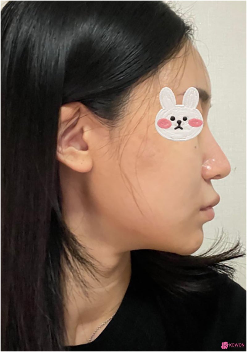 비순각교정 코수술알레르기 항생제 반응 복용 여부 사진 4
