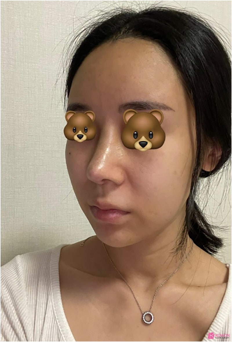 비순각교정 코수술알레르기 항생제 반응 복용 여부 사진 5