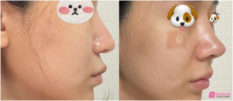 비순각교정 코수술알레르기 항생제 반응 복용 여부 사진 10