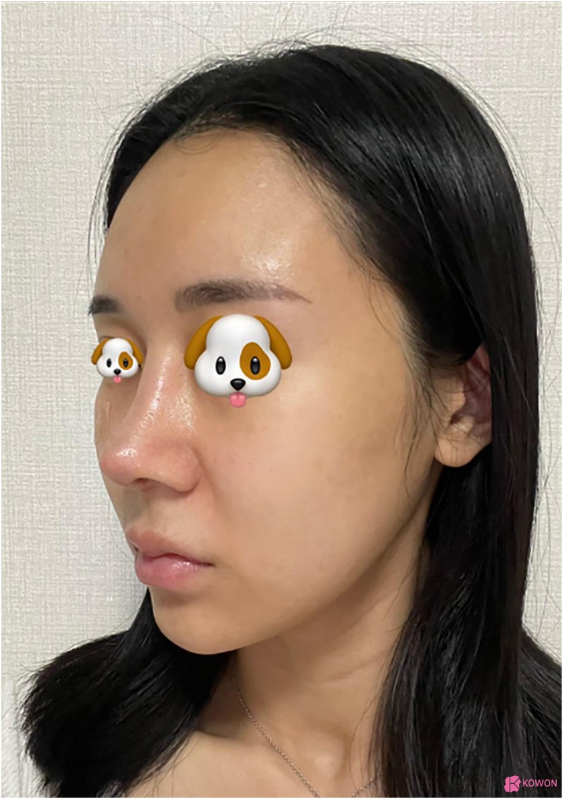 비순각교정 코수술알레르기 항생제 반응 복용 여부 사진 9