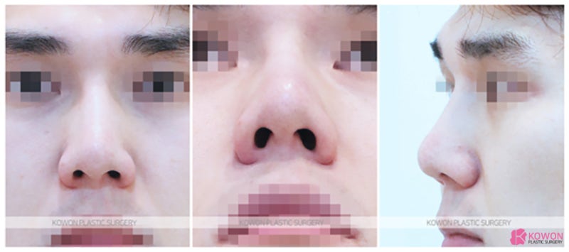 압구정코성형잘하는곳 콧대높이는수술 반영구 제거 필러 변화 사진 2
