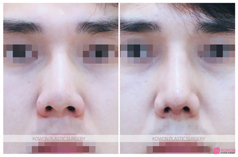 압구정코성형잘하는곳 콧대높이는수술 반영구 제거 필러 변화 사진 8