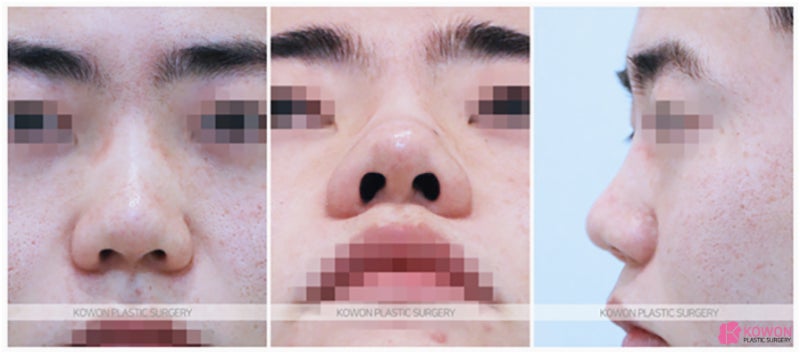 짧은코수술 복코성형외과 비중격연골 한계 실리콘 연장