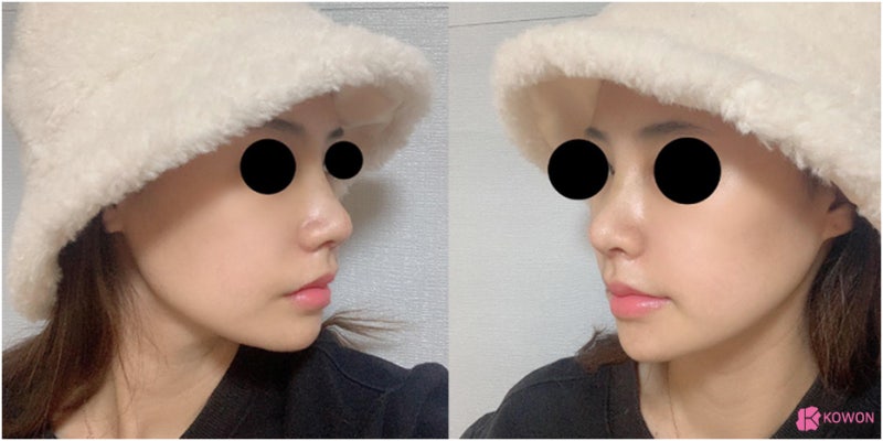 코수술후붓기 비중격만곡증수술후기 기간 진단 질병 사진 8