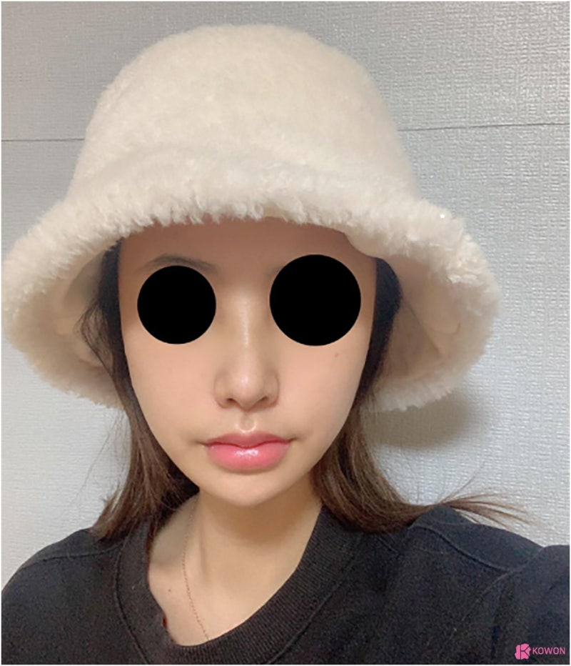 코수술후붓기 비중격만곡증수술후기 기간 진단 질병 사진 10