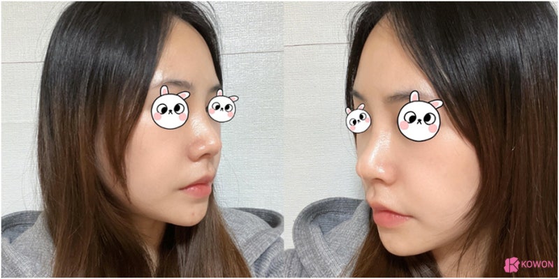코수술후붓기 비중격만곡증수술후기 기간 진단 질병 사진 13