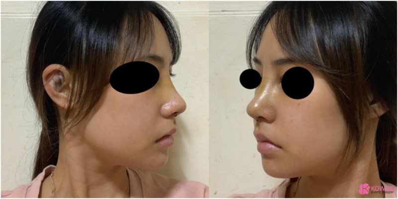 코수술후붓기 비중격만곡증수술후기 기간 진단 질병