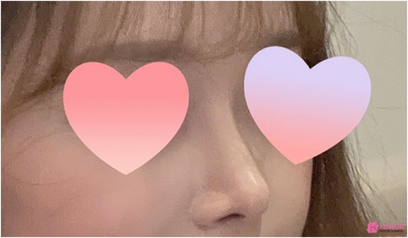 화살코성형 코기증늑연골 안전 채취과정 상담 방문