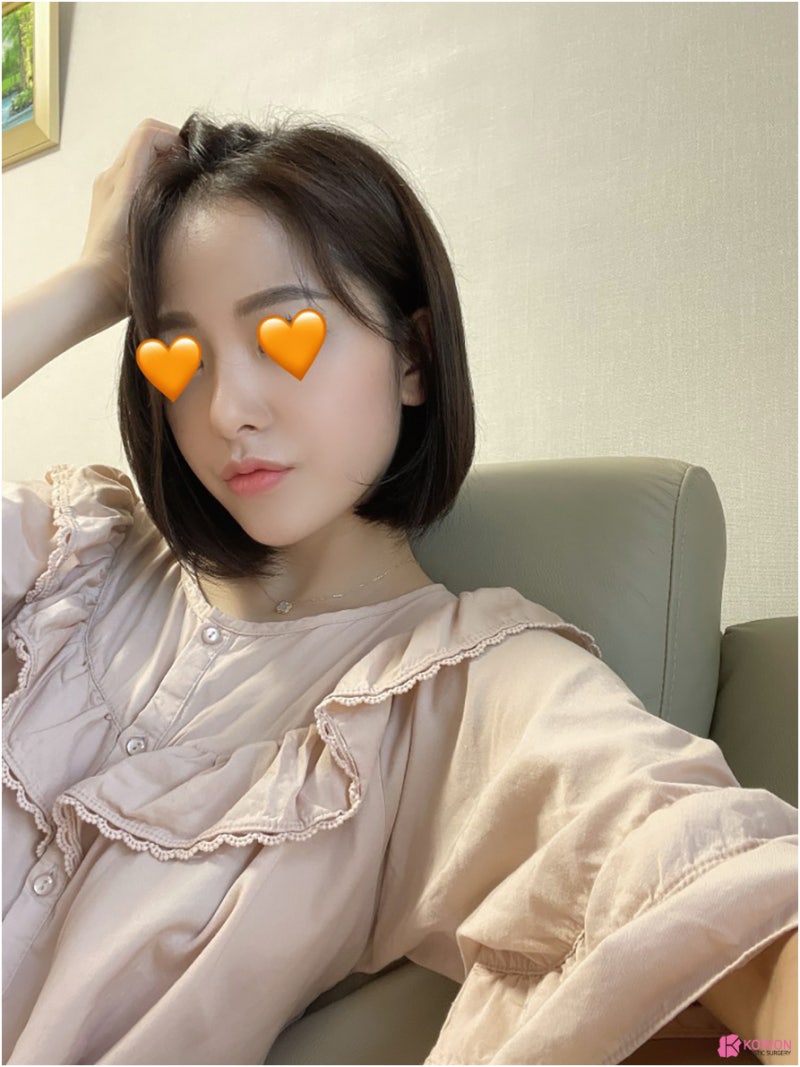 필러후코수술 코성형변화 디자인 직반버선 콧대 사진 13