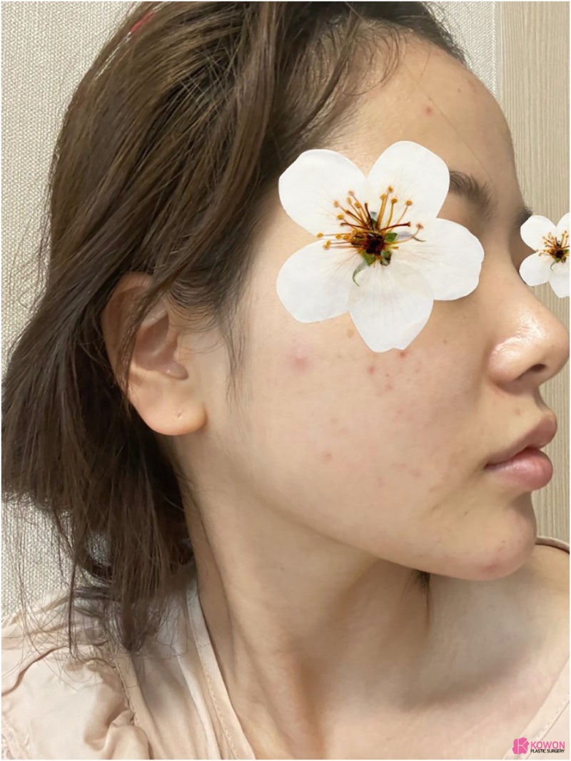 필러후코수술 코성형변화 디자인 직반버선 콧대 사진 4