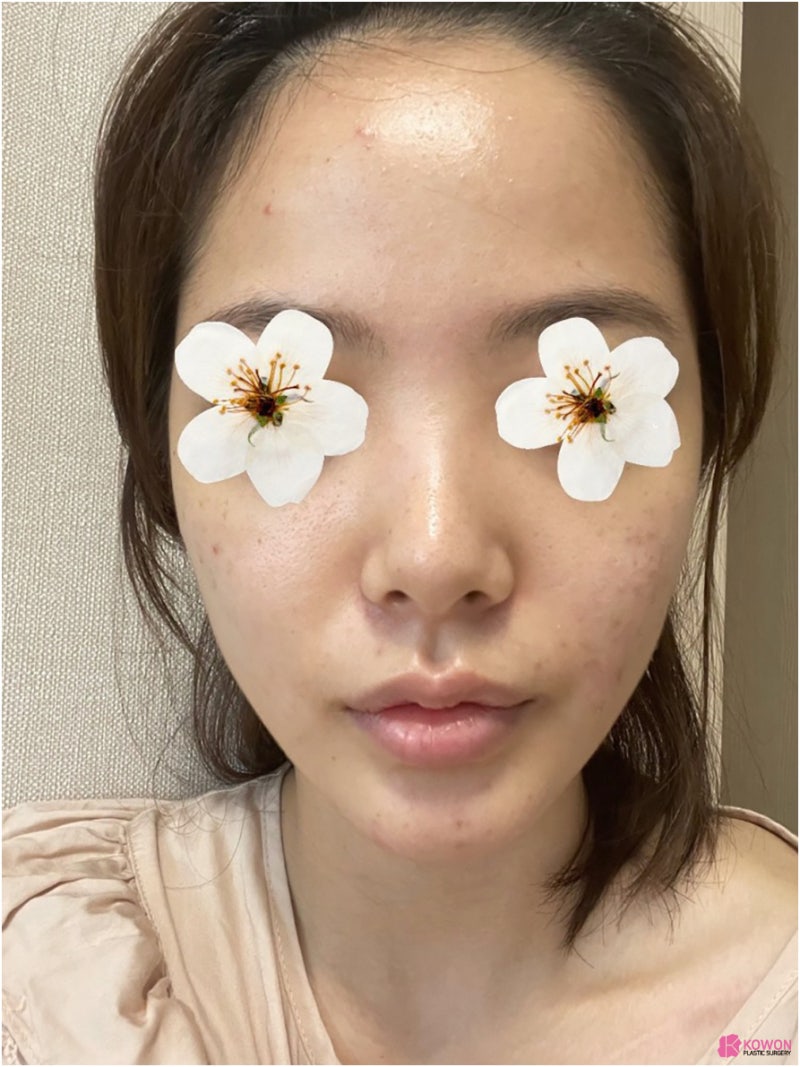 필러후코수술 코성형변화 디자인 직반버선 콧대 사진 3
