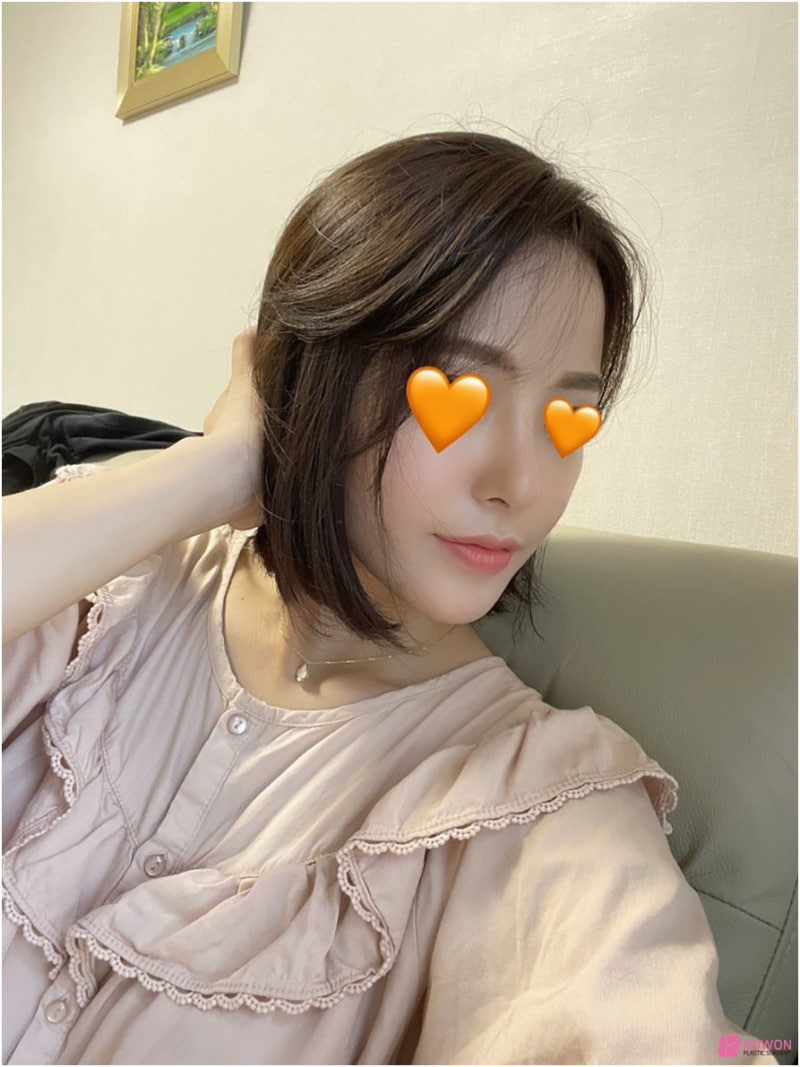 필러후코수술 코성형변화 디자인 직반버선 콧대 사진 11