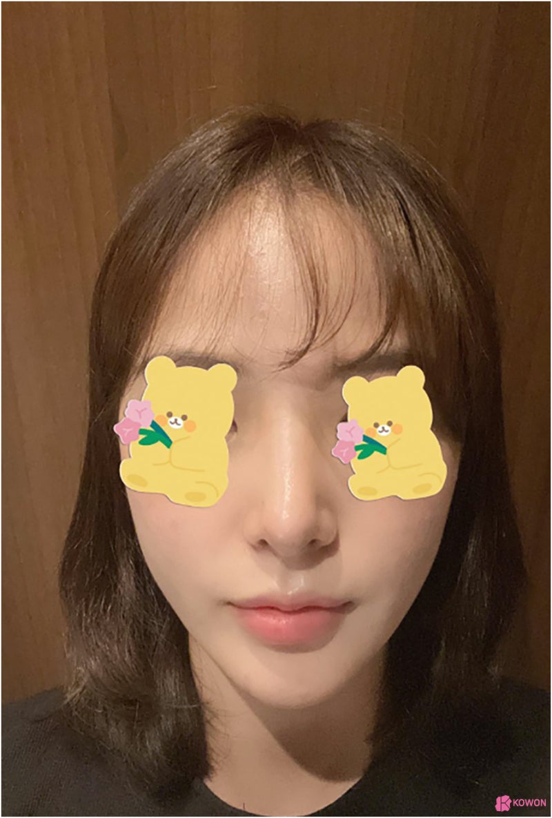 필러후코수술 코성형변화 디자인 직반버선 콧대 사진 7