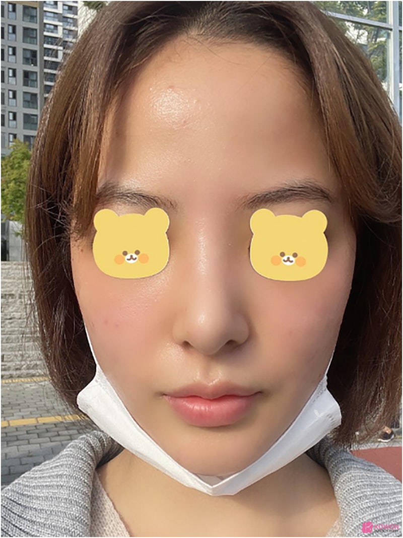 필러후코수술 코성형변화 디자인 직반버선 콧대 사진 10