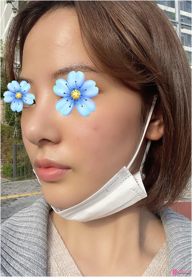 필러후코수술 코성형변화 디자인 직반버선 콧대 사진 9