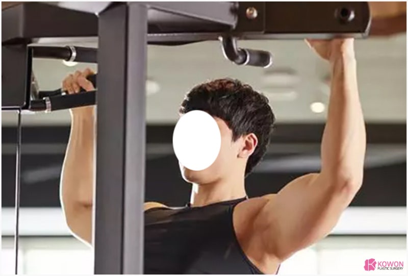 코성형 후 운동 헬스 주의사항 기간 출혈 혈압 사진 9