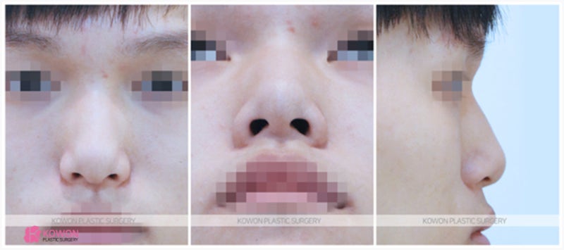 청담역코성형외과 낮은코끝수술 실리콘 보형물 사진 2