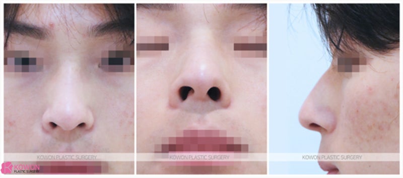 휜코교정 콤플렉스 해결 자연스러운코수술 방법 사진 2