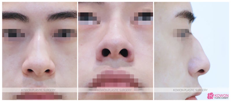 보형물없는코성형 압구정코수술 효과 변화 라인 매부리 사진 2