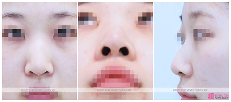 코성형외과추천 긴코수술후기 흉터 전후비교 사진 2