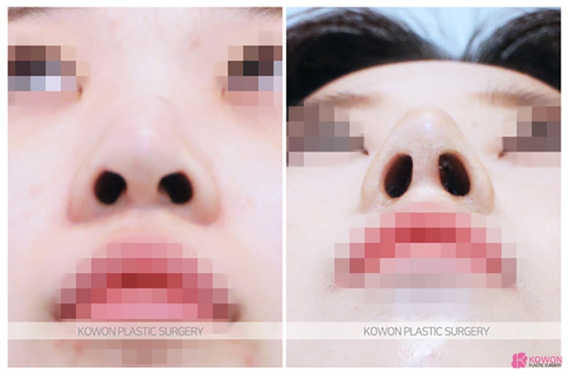코성형외과추천 긴코수술후기 흉터 전후비교 사진 4