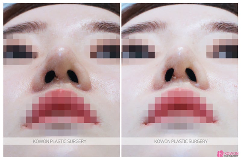코재수술성형외과 하이코제거 모양 필러 재수술 난이도 사진 8