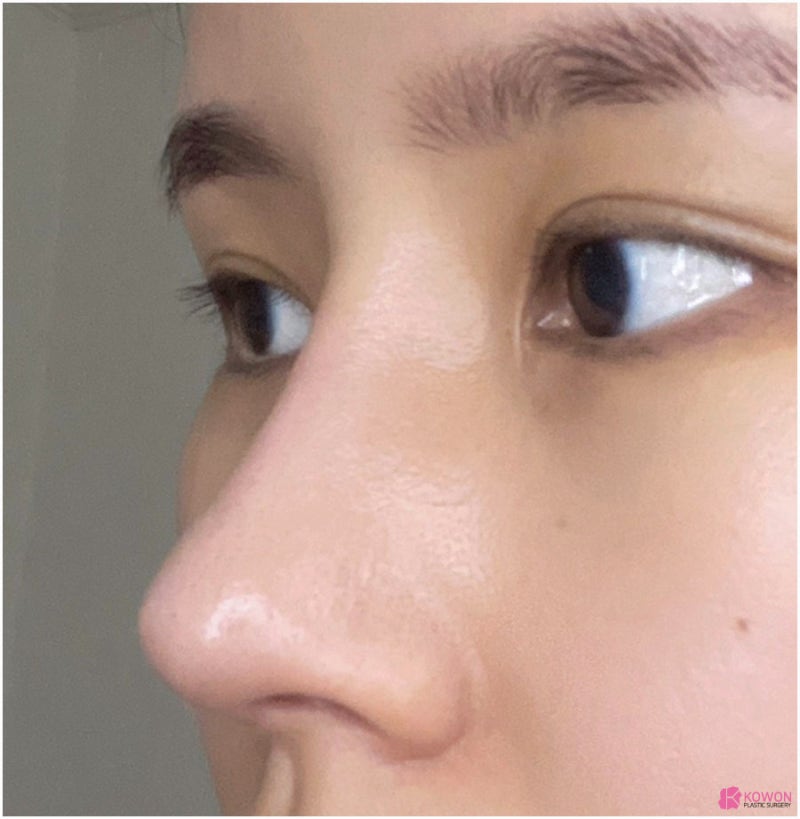 코끝연골재수술 코원성형외과 두 달 후기 사진 4