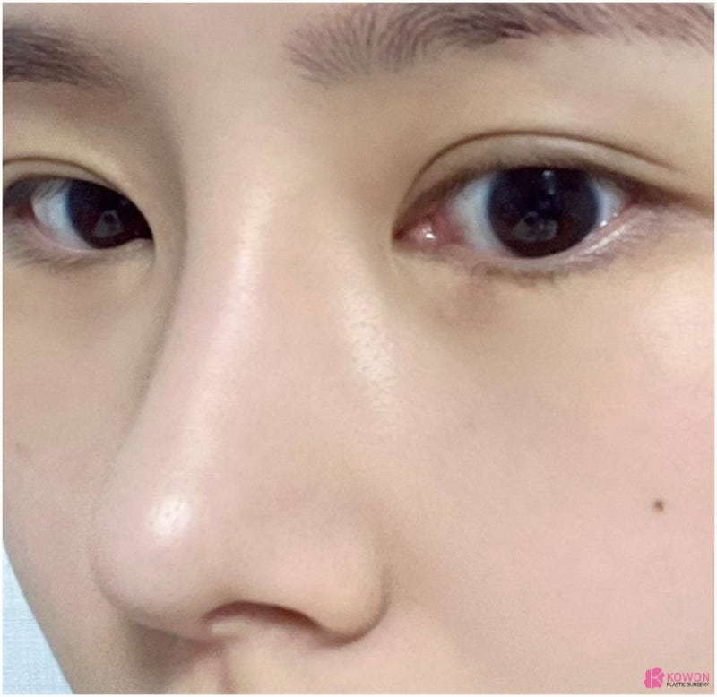 코끝연골재수술 코원성형외과 두 달 후기 사진 5