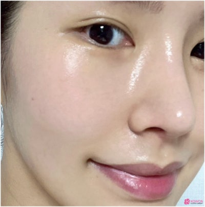 코끝연골재수술 코원성형외과 두 달 후기 사진 7