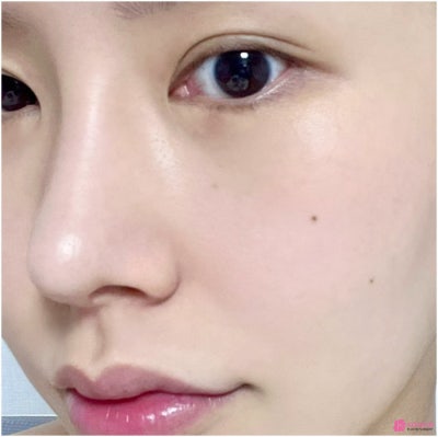 코끝연골재수술 코원성형외과 두 달 후기 사진 6